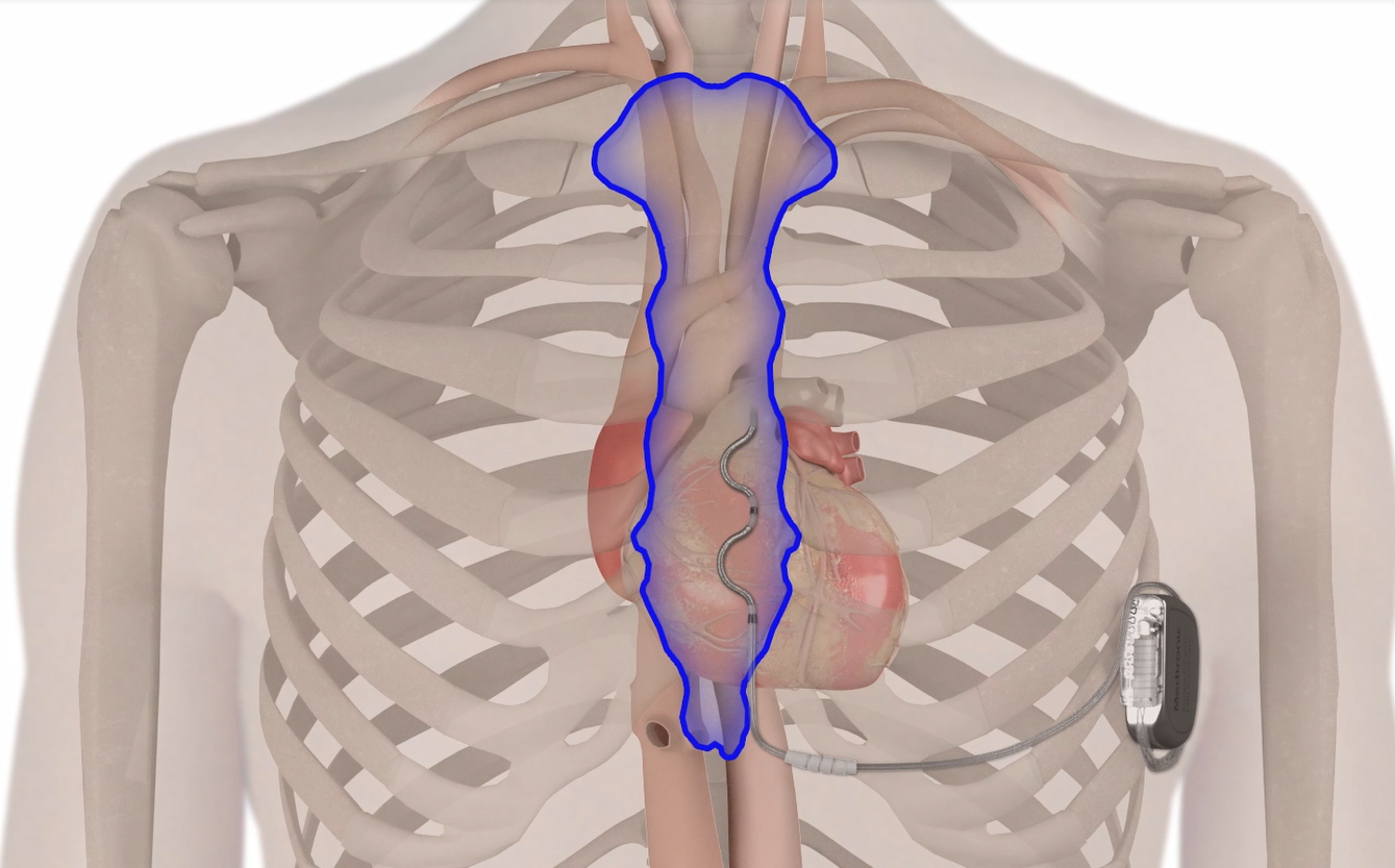 Medtronic animation.PNG