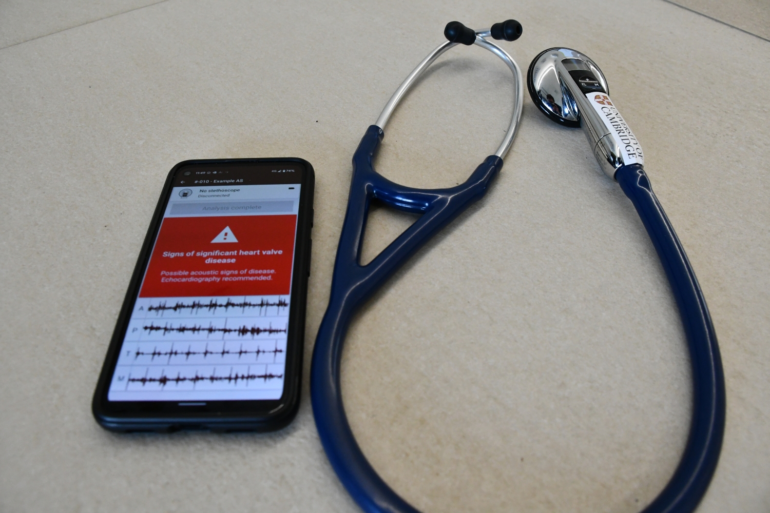 A smartphone screen next to a stethoscope shows sound recording wave patterns and a red banner saying 'signs of significant heart valve disease'.