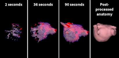 Ultrasound reconstruction of the left atrium using the AcQMap tool. Post-processing is performed to establish the final anatomy.